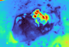 Fluorescent tumor fragment image